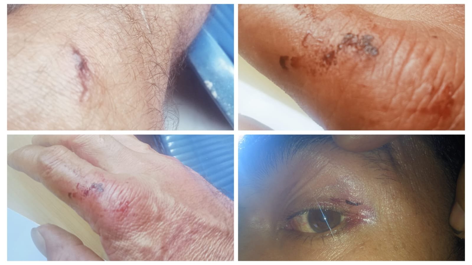 Keluarga Korban Mendesak Polsek Lahewa untuk segera Menangkap Pelaku Dugaan Penyerangan, Pengancaman dan Penganiayaan di Warga Desa Ombolata